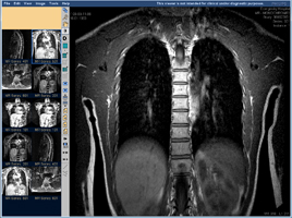 МРТ позвоночника, грудной отдел, фронтальная проекция