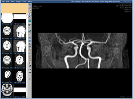 МР-ангиография сосудов головного мозга, фронтальная проекция