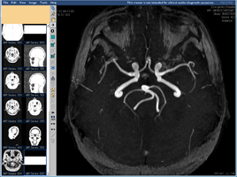 МР-ангиография сосудов головного мозга, аксиальная проекция